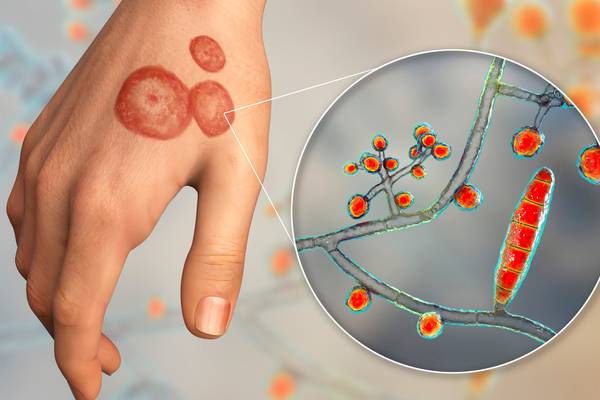 Drug-resistant ringworm found in US, CDC says