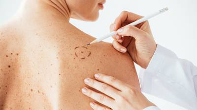 What is malignant melanoma? Signs, symptoms, treatment