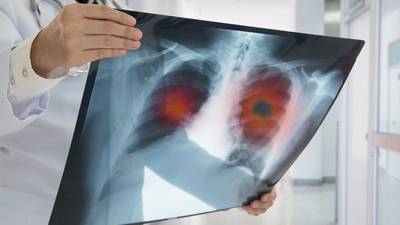 Lung cancer: Causes, symptoms, treatment for the disease