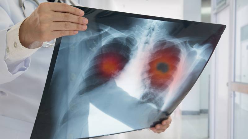 Lung cancer is the leading cause of cancer deaths in the United States.